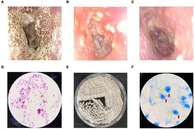 Identification of the Fungal Community in Otomycosis by Internal Transcribed Spacer Sequencing